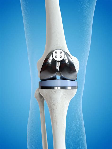 Total Joint Replacement .